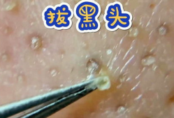 黑头视频,揭秘黑头成因及有效去除方法